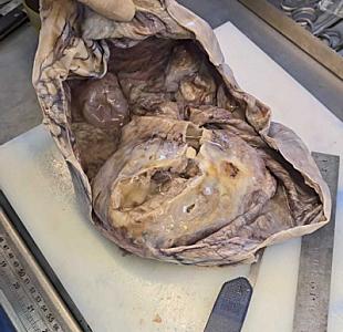 Bakıda qadının yumurtalığından nəhəng kist çıxarıldı -