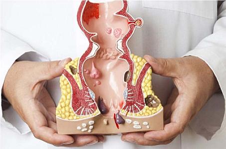 Babasili (hemoroid) olanlar nələrə diqqət etməlidir?