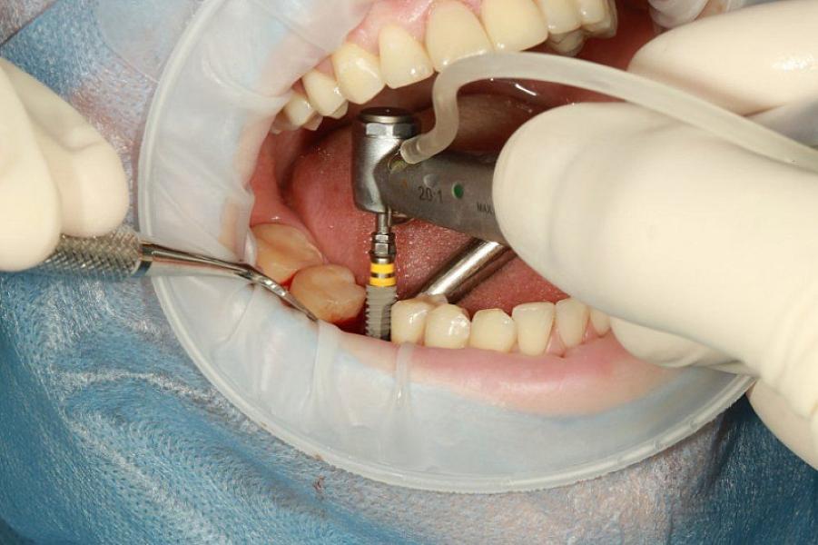 Bir gündə 12 implant diş qoyulan pasiyent öldü