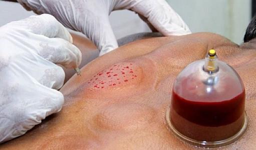 Bu şəxslərə hicama olmaz -