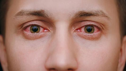 Qızarmış gözləri çay dəmləməsi ilə yumaq olar?