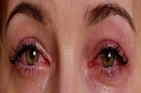 Gözləriniz qurudursa, nə etmək lazımdır?