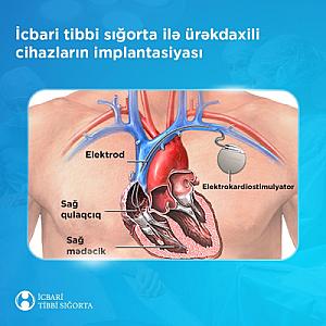 İcbari tibbi sığorta ilə qarşılanan aritmiyaların cərrahi müalicəsində