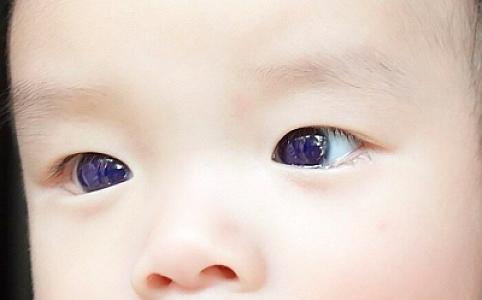 Koronavirusa qarşı dərman qəbul edən körpənin gözlərinin rəngi bənövşəyi olub