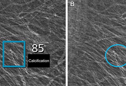 Süni intellektin tətbiqi xərçəngin aşkarlanmasını