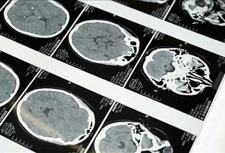 Nitq pozğunluğu insult əlaməti