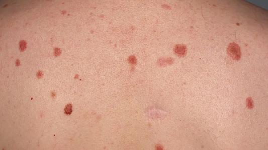 Dərinizdəki qırmızı xallar nədən yaranır? –