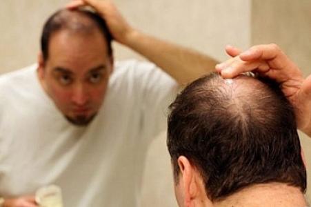 Keçəlliyin qarşısını alan