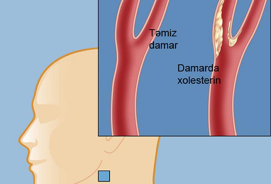 Xolesterinin və yüksək təzyiqin birinci düşməni -