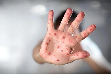 Meymunçiçəyi virusu yayılır: