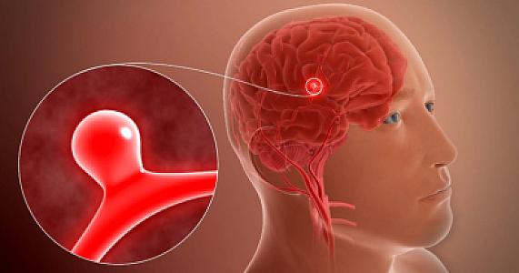 Beyin anevrizması əməliyyatı icbari tibbi sığorta ilə qarşılanır? -