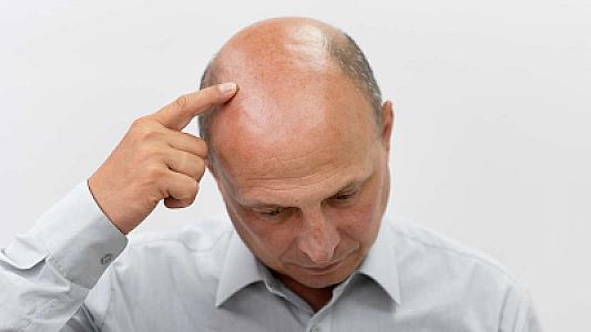 Alkoqol qəbul edənlər daha çox keçəl olur? -