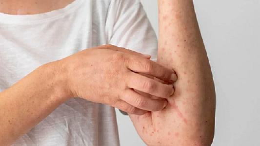 Meymunçiçəyi daha təhlükəli oldu: