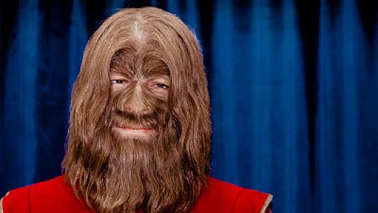 11 uşaqda "qurd adam sindromu" aşkarlandı -