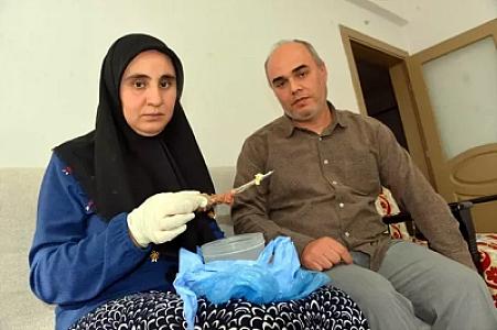 Qadın 7 il mədəsində qayçı ilə yaşayıb