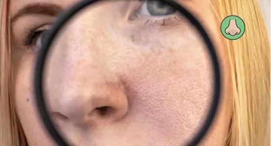 Burun və çənədəki qara nöqtələri təmizləmək üçün