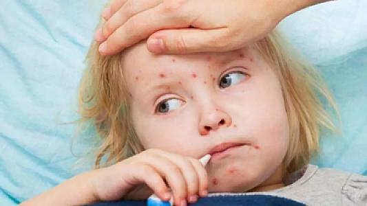 TƏBİB: Qızılcaya yoluxma halı