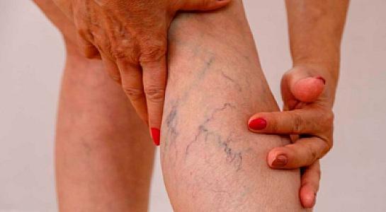 Varikozun yeganə effektiv müalicə