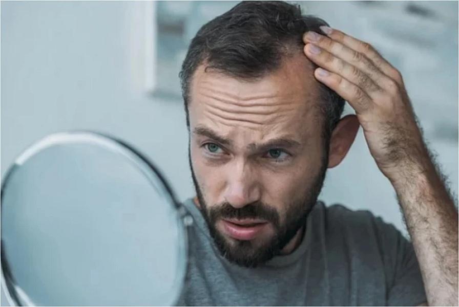 Barmaqlar əsasında keçəlləşməni necə təyin etmək olar? -