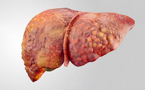 Qaraciyərin piylənməsi xərçəng xəstəliyinə necə səbəb olur? -