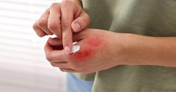 Yanıq zamanı çox adam bu səhvi edir: