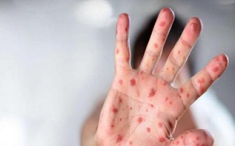 SN: "Bəzi bölgələrdə qızılcaya yoluxma halları müşahidə edilib, epidemioloji vəziyyət stabildir"