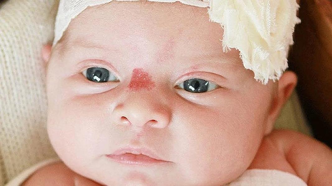 Hemangioma nədir?