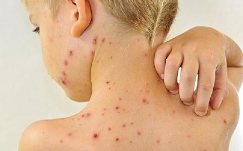 Bu il Azərbaycanda qızılcaya yoluxanların sayı açıqlanıb