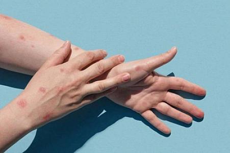 Azərbaycanda meymunçiçəyi virusuna ilk yoluxan