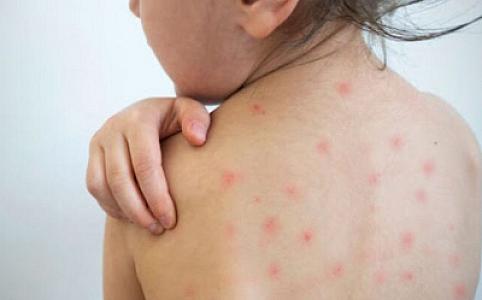 Pediatr qızılcadan qorunmağın yollarını açıqlayıb