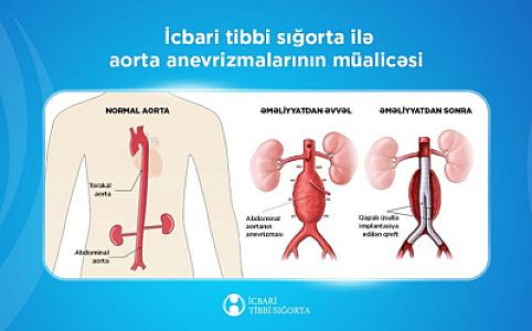 Aorta anevrizmalarının protezləşdirilməsi ilə bağlı