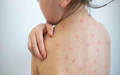 Bakıda sığınacaqda çox sayda uşaq qızılcaya yoluxub