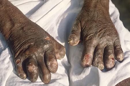 "Şeytan xəstəliyi" - Bəşəriyyəti ilk sarsıdan