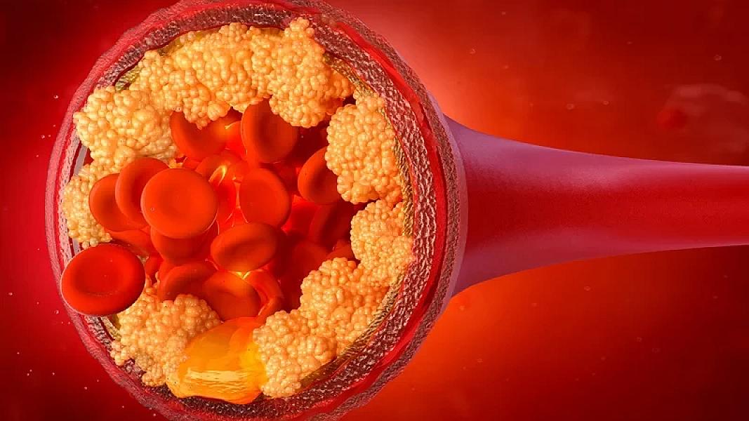 Diyetoloq xolesterolu aşağı salan qidaları
