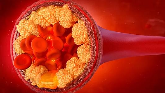 Diyetoloq xolesterolu aşağı salan qidaları