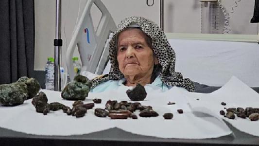 92 yaşlı qadının mədə-bağırsağından çıxanlar həkimləri ŞOKA saldı -