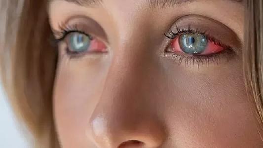 Qırmızı gözlər üçün həkimə müraciət edin: