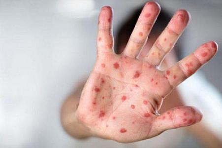 Bakıda sığınacağda qızılcaya yoluxan uşaqların son durumu açıqlanıb