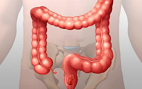 Tutulmuş bağırsaqları açan