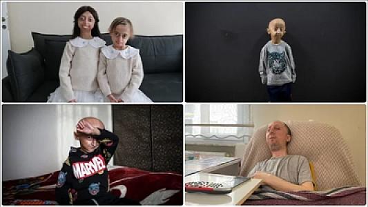 400 milyon insanı əhatə edən nadir xəstəliklər: