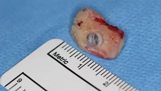 İnqilabi müalicə: Kor xəstəyə