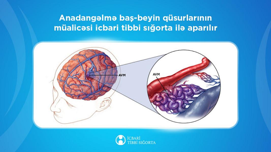Anadangəlmə baş-beyin qüsurlarının açıq üsulla əməliyyatı