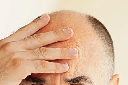 Keçəlliyin dərmanı tapıldı: