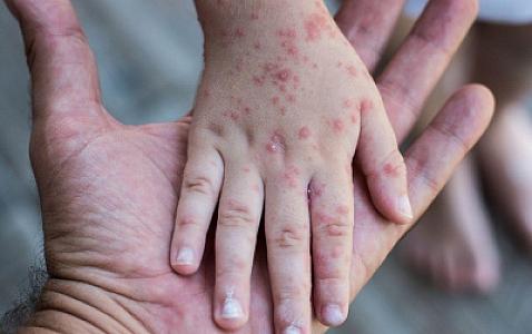 "Uşaq qızılca xəstəsi ilə təmasda olduğu təqdirdə o, 72 saat ərzində qızılcaya qarşı peyvənd edilməlidir" - İnfeksionist