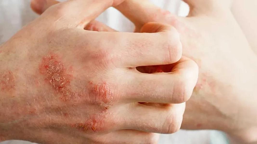 Psoriaz və ekzema üçün faydalıdır, sızanaq yaradan bakteriyaları yox edir: