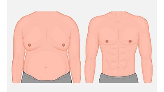 Kişilərdə ginekomastiya problemi artır: