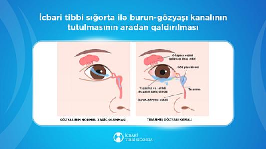 Gözyaşı axarının bərpası məqsədi ilə 234 oftalmoloji əməliyyat