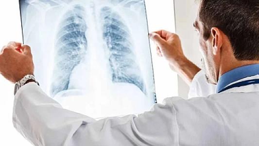 Bu barmaq əlaməti ağciyər xərçənginin