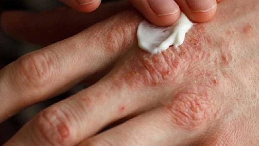 Dəridəki bu əlamətə diqqət!