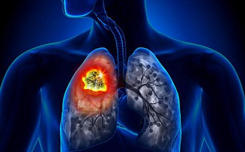 Alimlər ölümcül ağciyər xəstəliyinin səbəbini